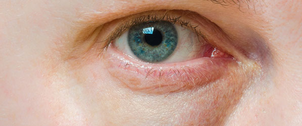 Get Rid of Under Eye Bags